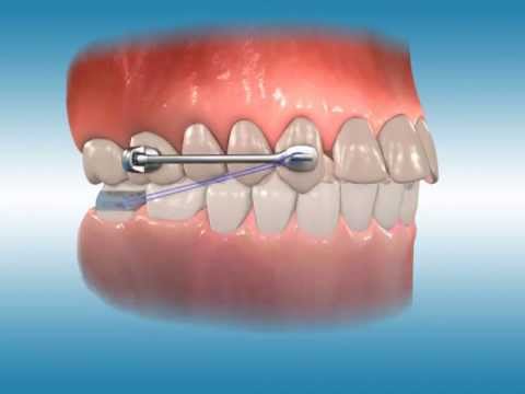 Carriere Motion 3D Class II Appliance