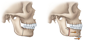 jaw surgery